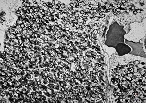 M, 6m. | Niemann-Pick disease - spleen M, 6m. | Niemann-Pick disease - spleen